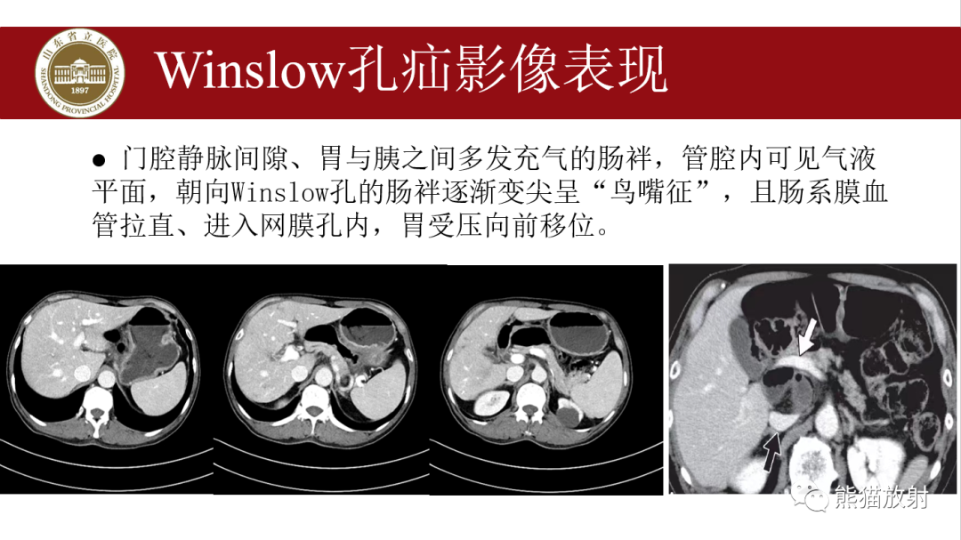 影像PPT - 【PPT】腹内疝影像表现-18