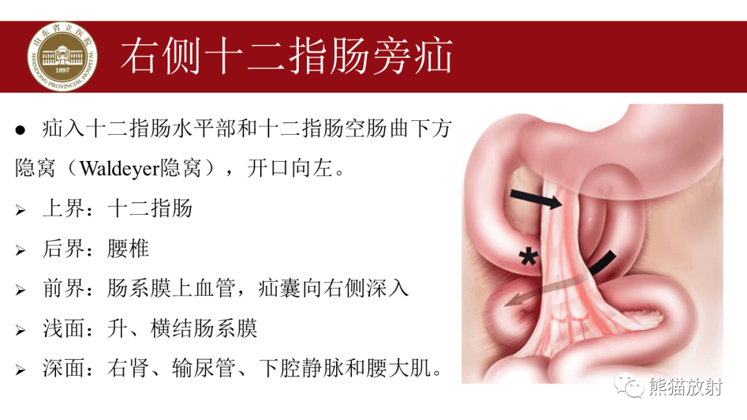 影像PPT - 【PPT】腹内疝影像表现-12