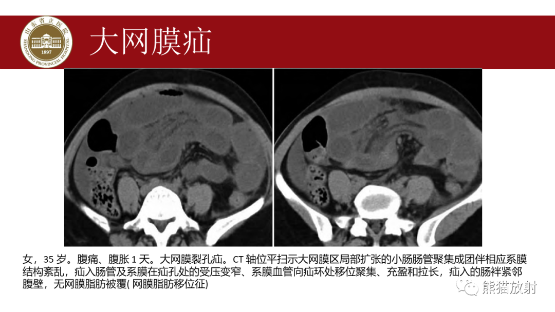 影像PPT - 【PPT】腹内疝影像表现-21