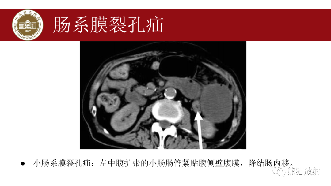 影像PPT - 【PPT】腹内疝影像表现-24
