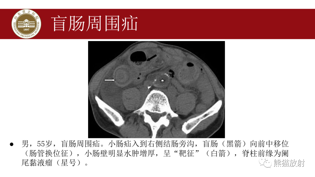 影像PPT - 【PPT】腹内疝影像表现-26