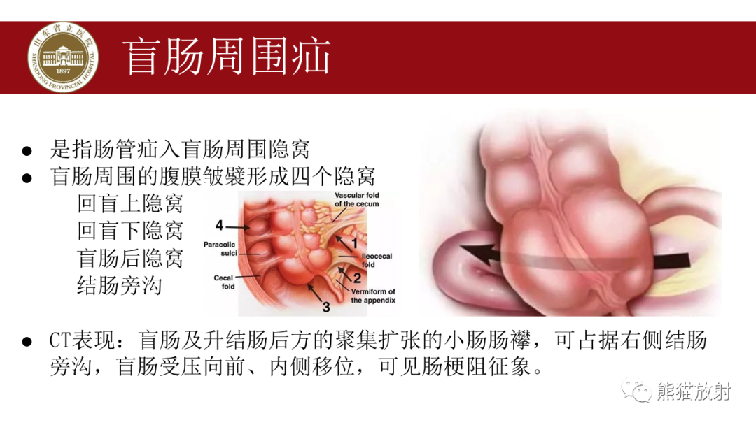 影像PPT - 【PPT】腹内疝影像表现-25