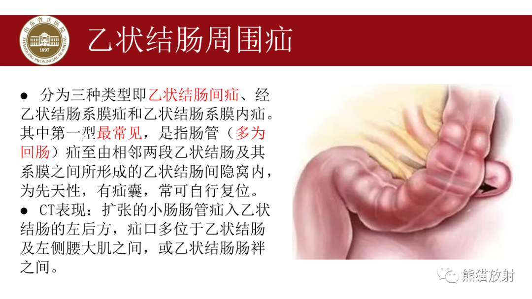 影像PPT - 【PPT】腹内疝影像表现-27