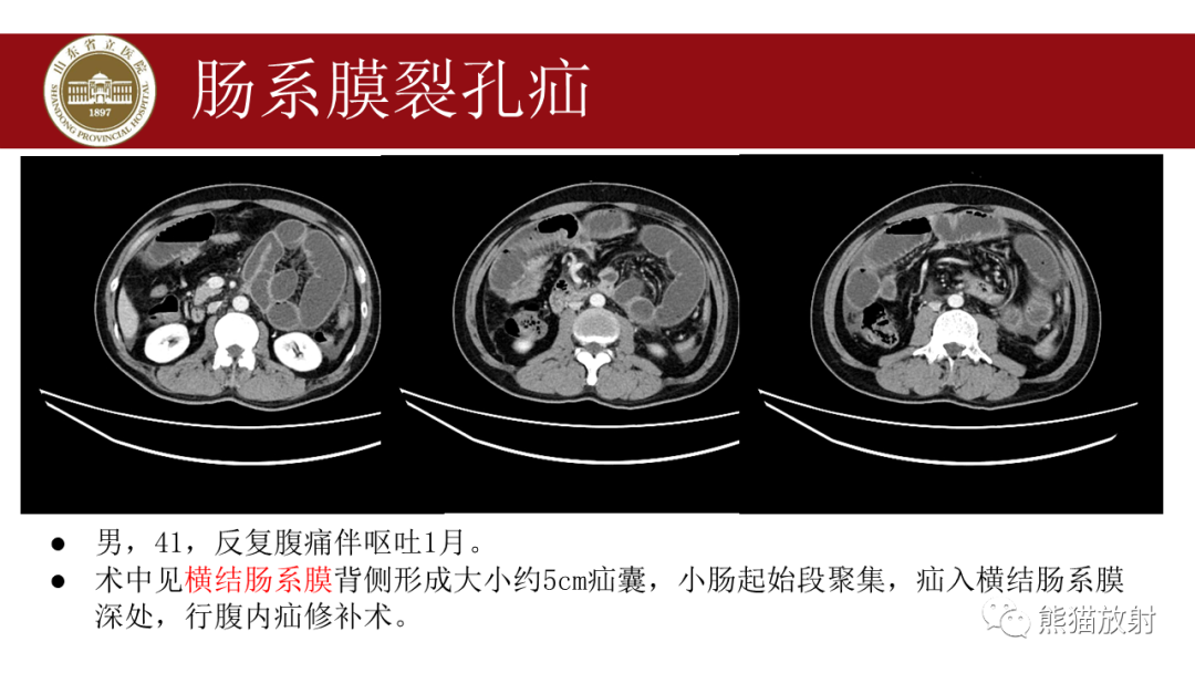 影像PPT - 【PPT】腹内疝影像表现-23