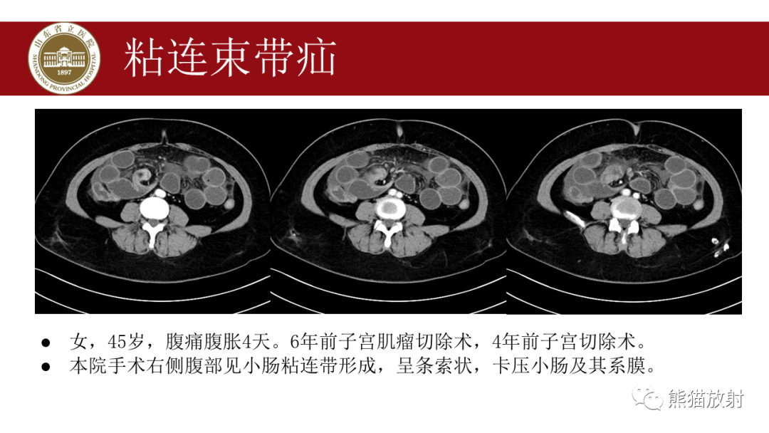 影像PPT - 【PPT】腹内疝影像表现-31