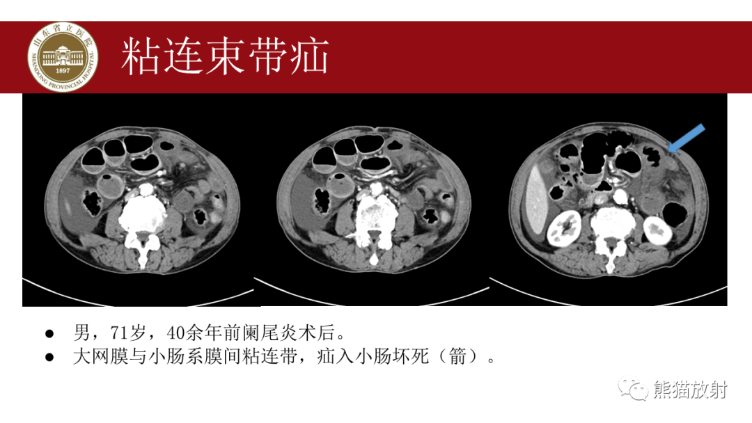 影像PPT - 【PPT】腹内疝影像表现-32