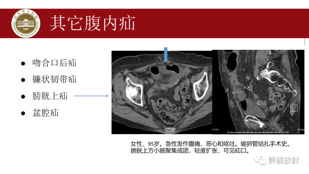 影像PPT - 【PPT】腹内疝影像表现-33