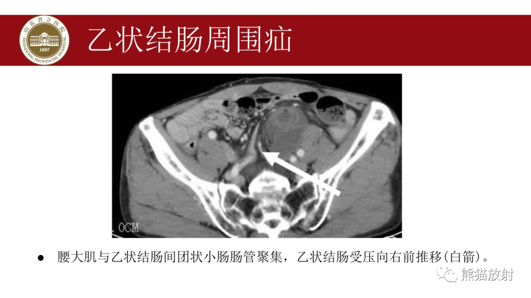 影像PPT - 【PPT】腹内疝影像表现-28