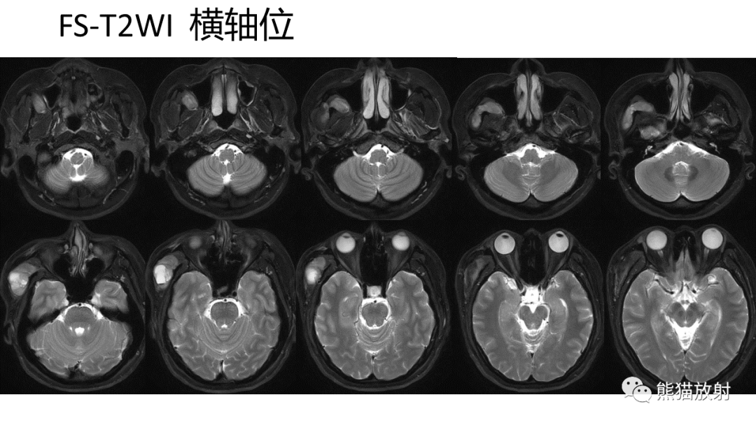 影像PPT - 【PPT】颞下窝滑膜肉瘤 VS 横纹肌肉瘤-6