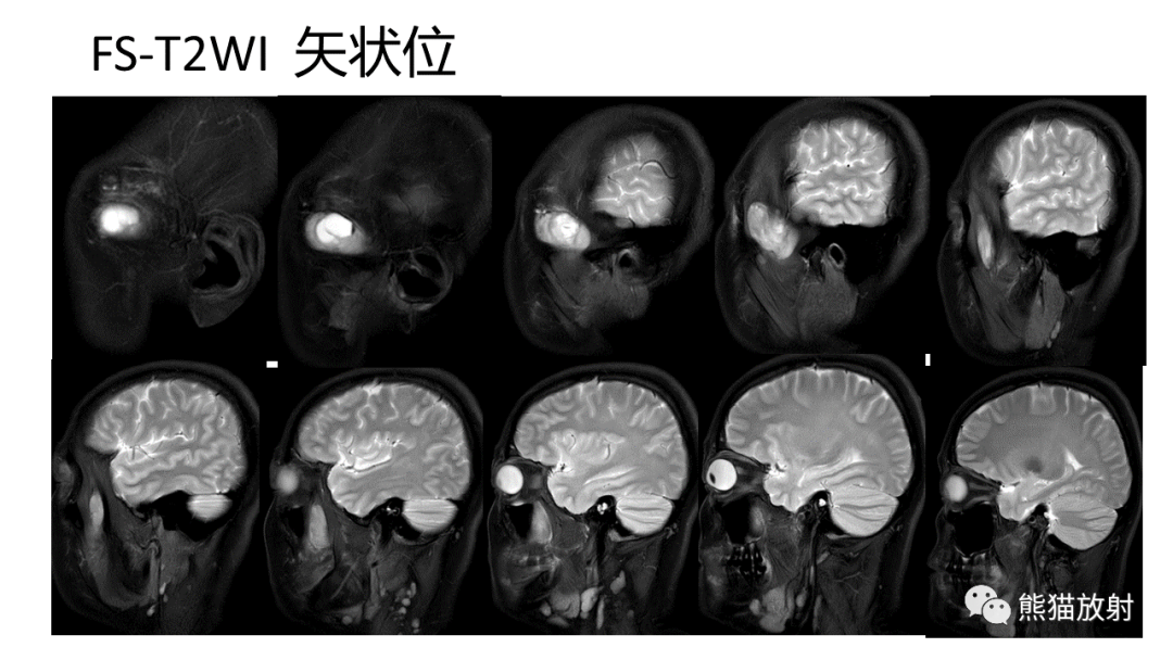 影像PPT - 【PPT】颞下窝滑膜肉瘤 VS 横纹肌肉瘤-7