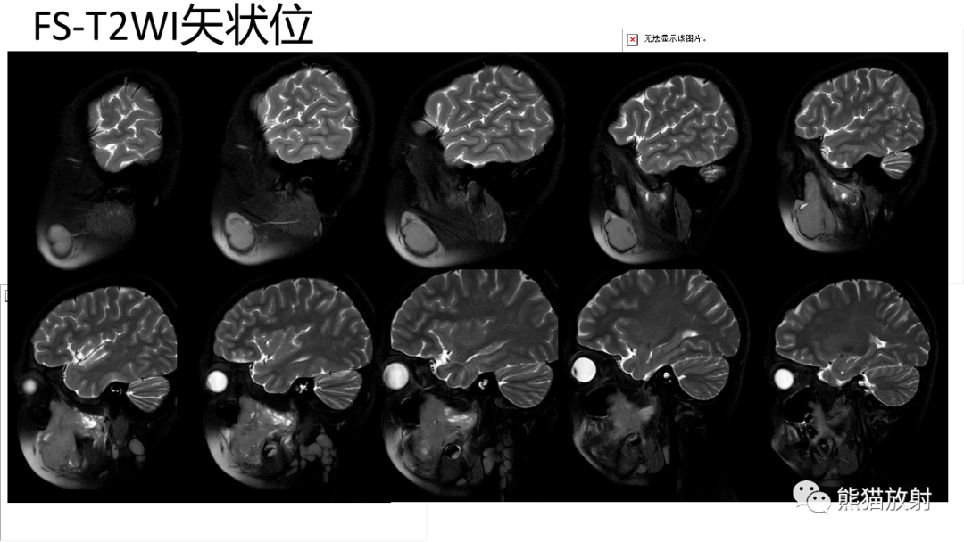 影像PPT - 【PPT】颞下窝滑膜肉瘤 VS 横纹肌肉瘤-22