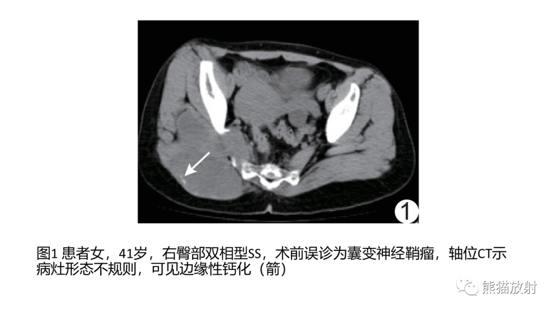 影像PPT - 【PPT】颞下窝滑膜肉瘤 VS 横纹肌肉瘤-41