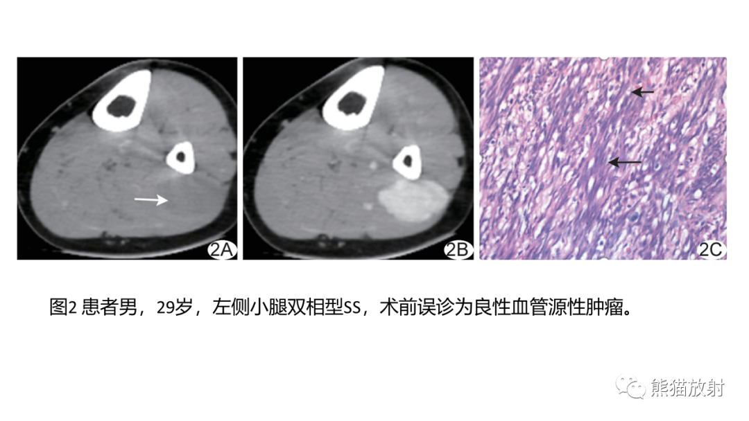 影像PPT - 【PPT】颞下窝滑膜肉瘤 VS 横纹肌肉瘤-42