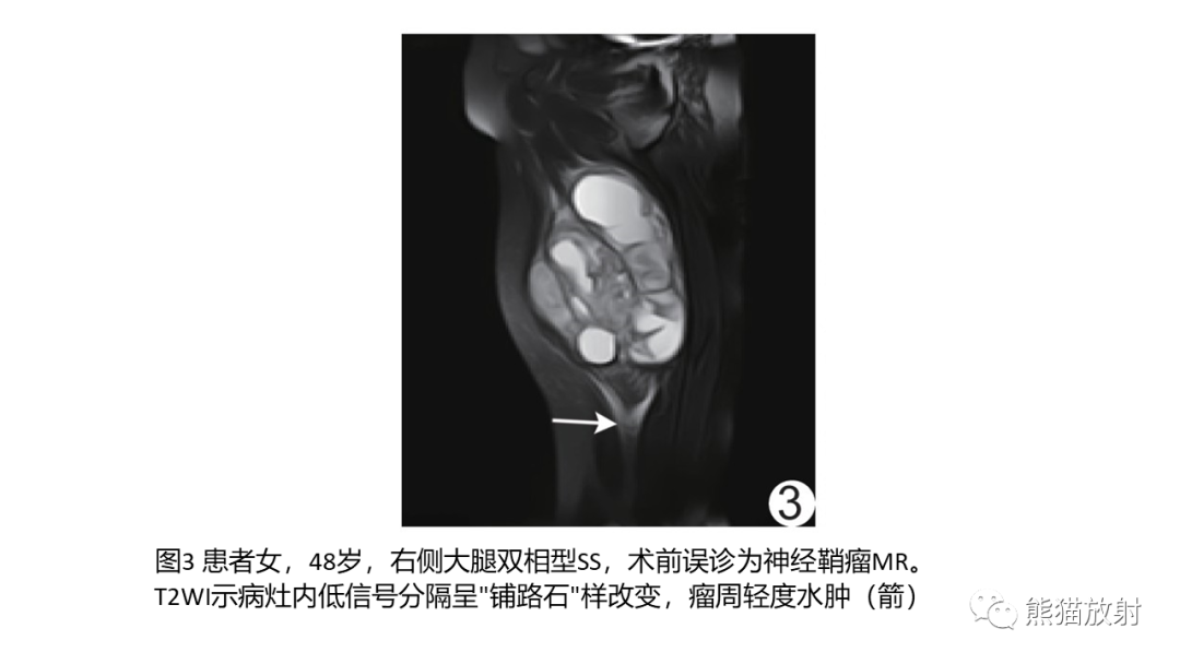 影像PPT - 【PPT】颞下窝滑膜肉瘤 VS 横纹肌肉瘤-43