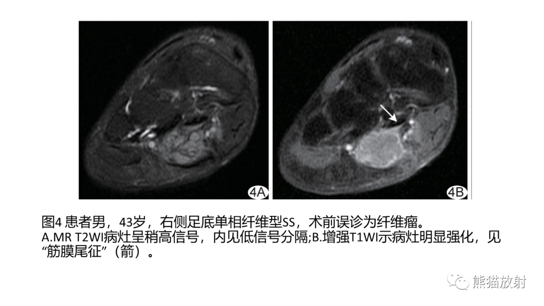 影像PPT - 【PPT】颞下窝滑膜肉瘤 VS 横纹肌肉瘤-44