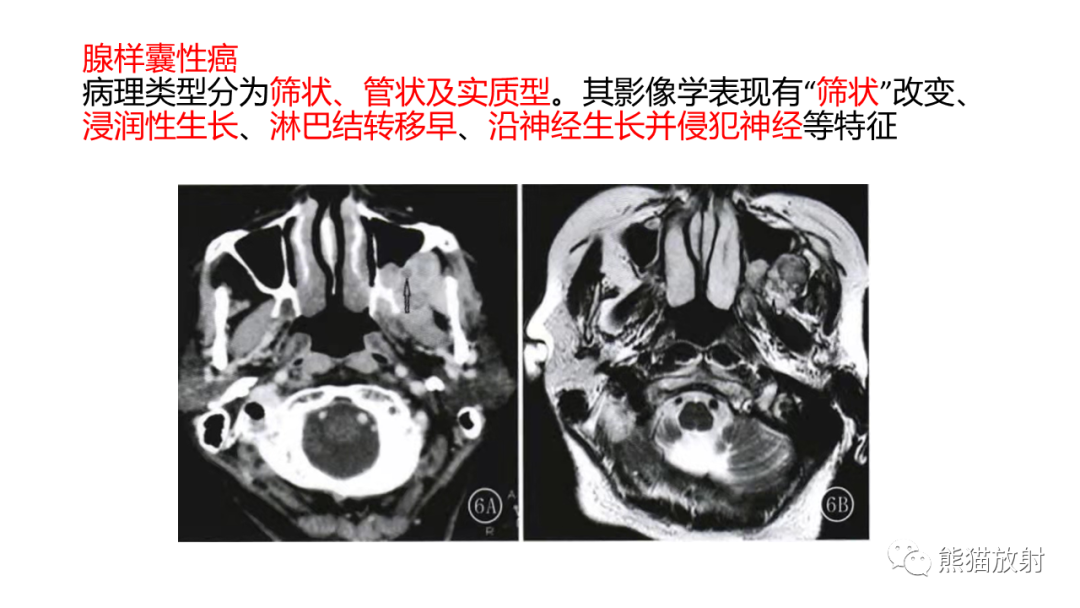 影像PPT - 【PPT】颞下窝滑膜肉瘤 VS 横纹肌肉瘤-53