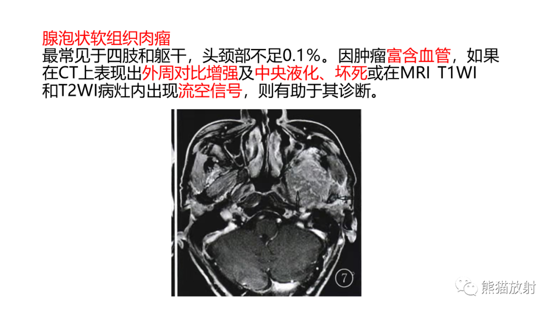 影像PPT - 【PPT】颞下窝滑膜肉瘤 VS 横纹肌肉瘤-54