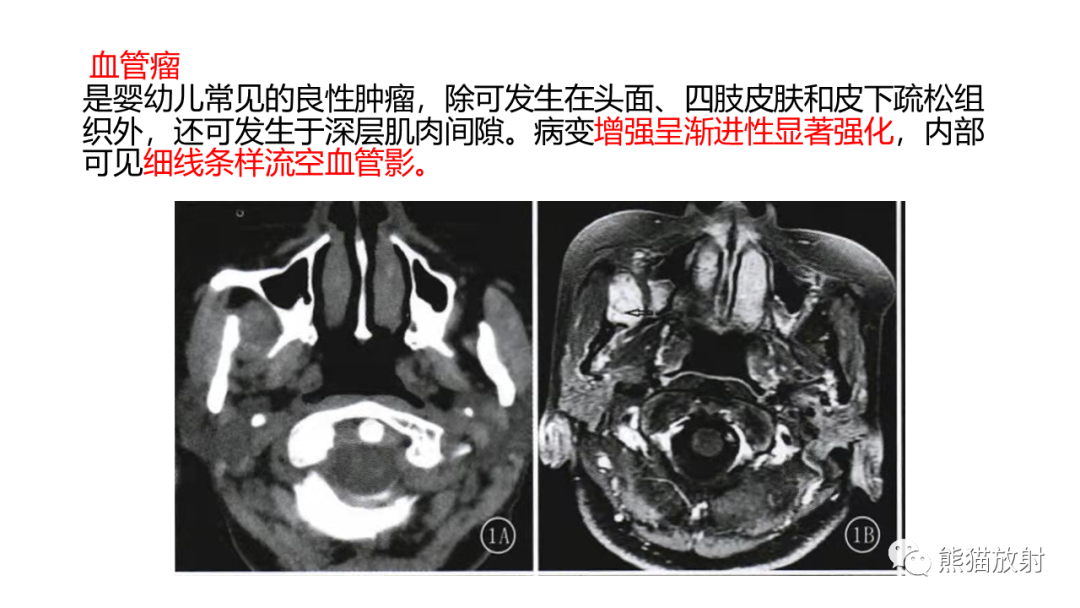 影像PPT - 【PPT】颞下窝滑膜肉瘤 VS 横纹肌肉瘤-50