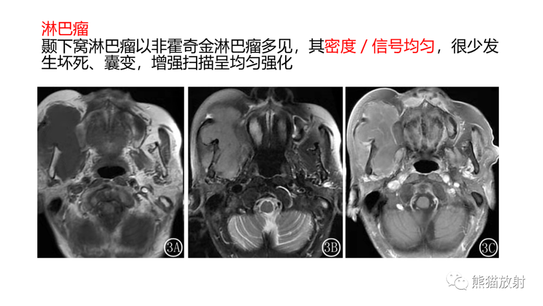 影像PPT - 【PPT】颞下窝滑膜肉瘤 VS 横纹肌肉瘤-55