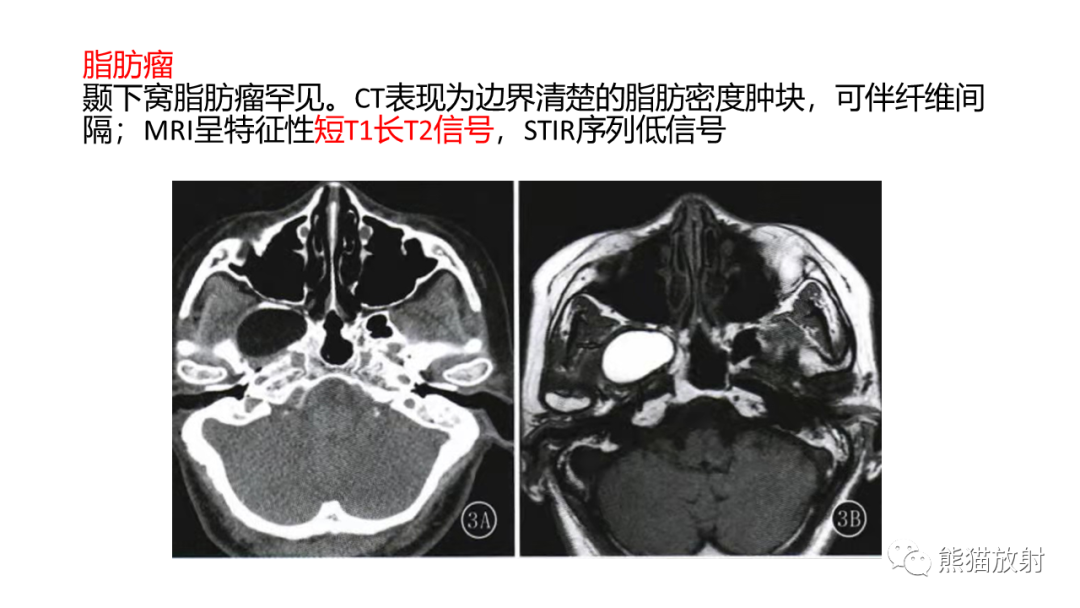 影像PPT - 【PPT】颞下窝滑膜肉瘤 VS 横纹肌肉瘤-52