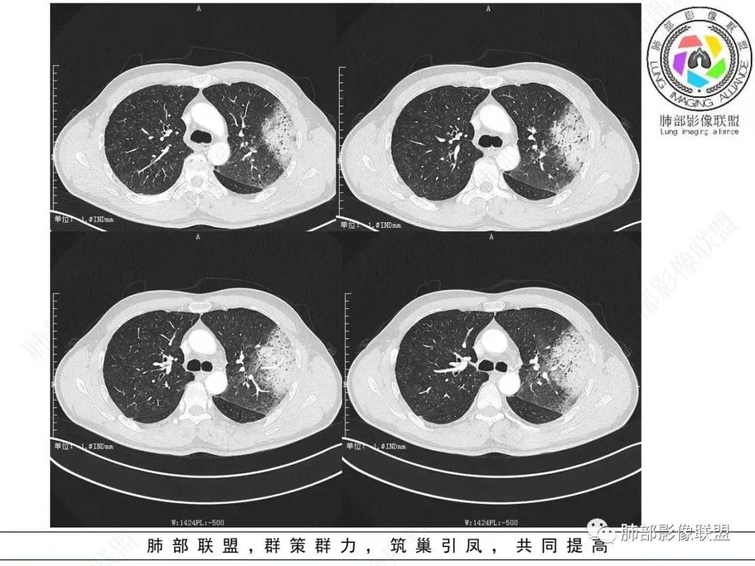 影像PPT - 【病例】 最经典的肺炎型肺癌1例CT-6 影像PPT - 【病例】 最经典的肺炎型肺癌1例CT-6