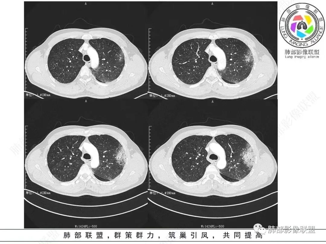 影像PPT - 【病例】 最经典的肺炎型肺癌1例CT-5 影像PPT - 【病例】 最经典的肺炎型肺癌1例CT-5