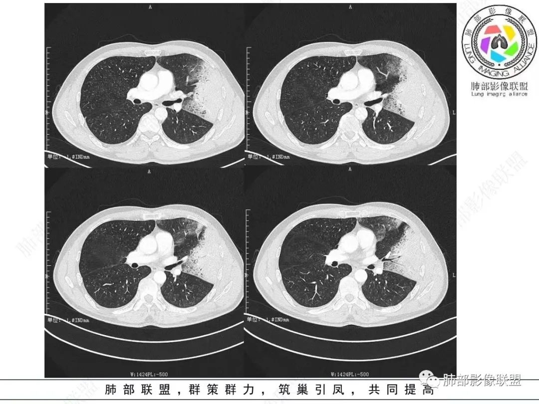 影像PPT - 【病例】 最经典的肺炎型肺癌1例CT-9 影像PPT - 【病例】 最经典的肺炎型肺癌1例CT-9
