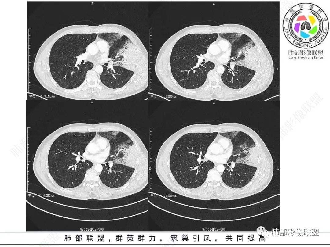 影像PPT - 【病例】 最经典的肺炎型肺癌1例CT-10 影像PPT - 【病例】 最经典的肺炎型肺癌1例CT-10