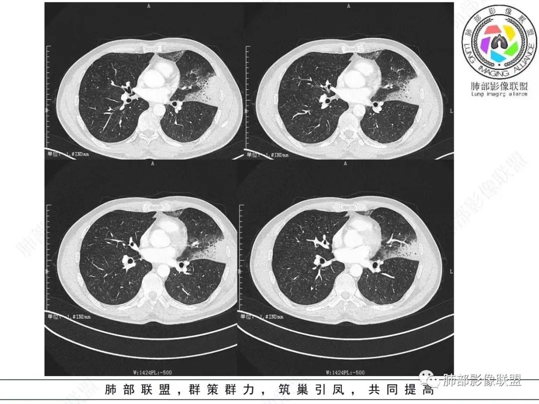 影像PPT - 【病例】 最经典的肺炎型肺癌1例CT-11 影像PPT - 【病例】 最经典的肺炎型肺癌1例CT-11