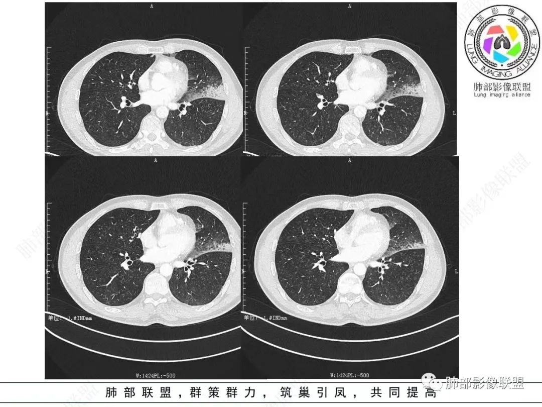 影像PPT - 【病例】 最经典的肺炎型肺癌1例CT-12 影像PPT - 【病例】 最经典的肺炎型肺癌1例CT-12