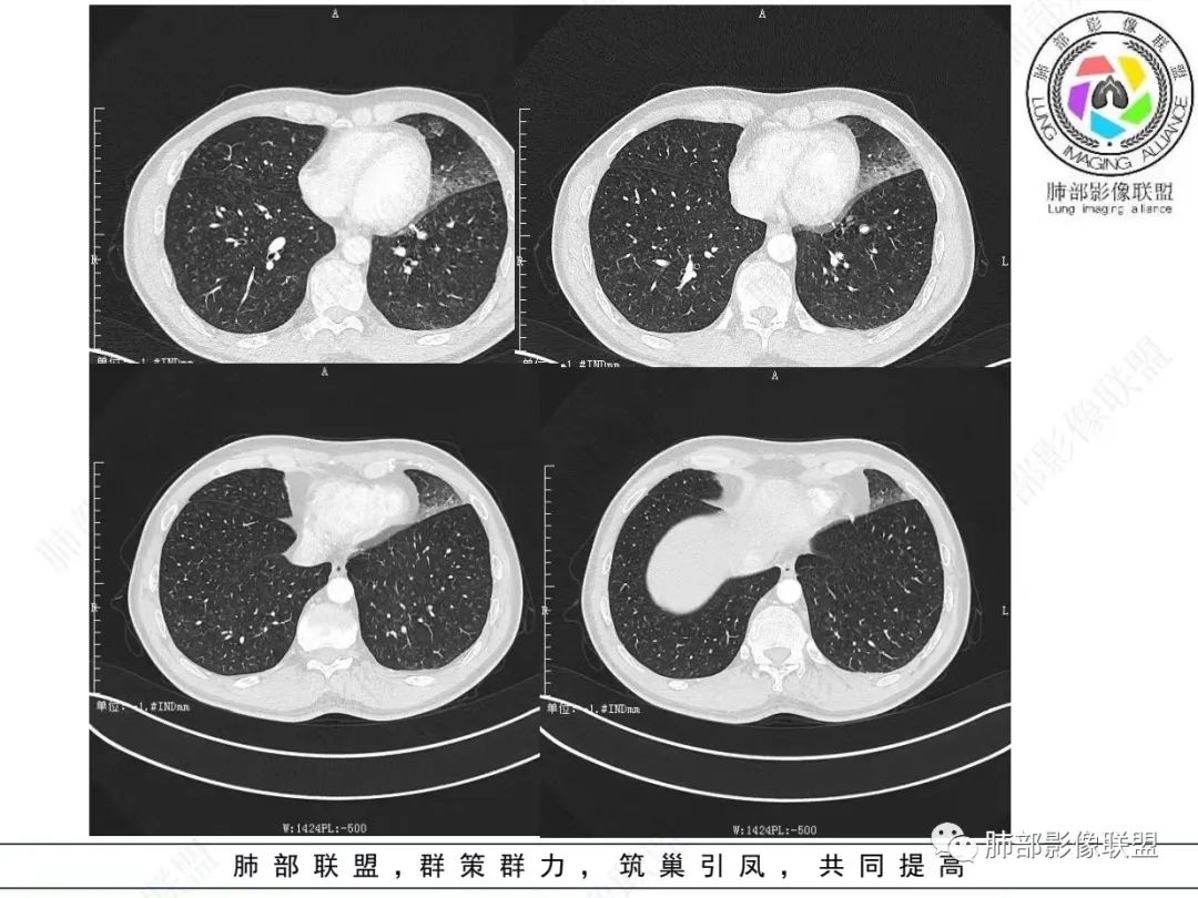 影像PPT - 【病例】 最经典的肺炎型肺癌1例CT-13 影像PPT - 【病例】 最经典的肺炎型肺癌1例CT-13