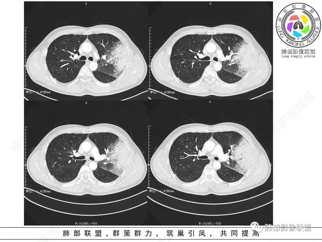 影像PPT - 【病例】 最经典的肺炎型肺癌1例CT-7 影像PPT - 【病例】 最经典的肺炎型肺癌1例CT-7