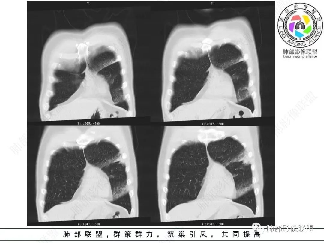 影像PPT - 【病例】 最经典的肺炎型肺癌1例CT-14 影像PPT - 【病例】 最经典的肺炎型肺癌1例CT-14