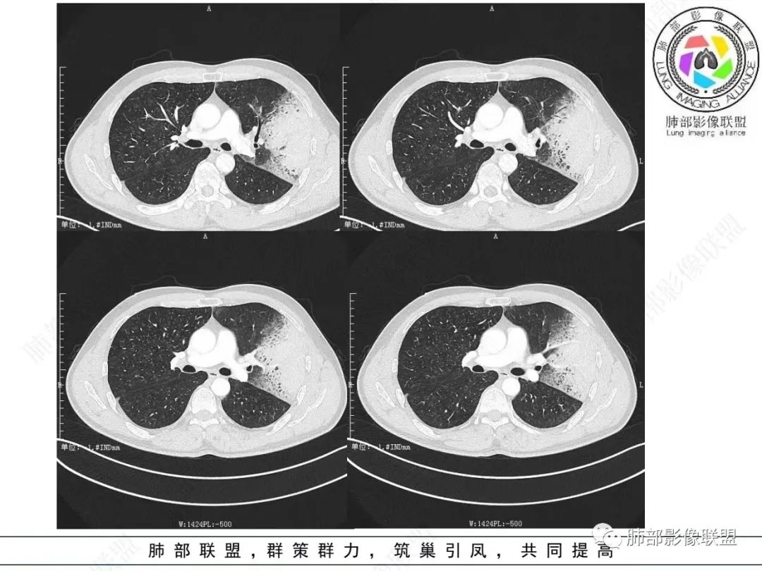 影像PPT - 【病例】 最经典的肺炎型肺癌1例CT-8 影像PPT - 【病例】 最经典的肺炎型肺癌1例CT-8