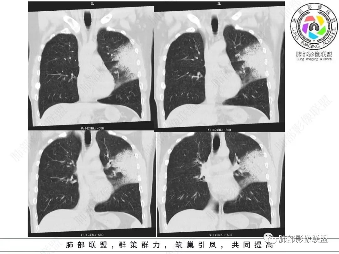 影像PPT - 【病例】 最经典的肺炎型肺癌1例CT-16 影像PPT - 【病例】 最经典的肺炎型肺癌1例CT-16