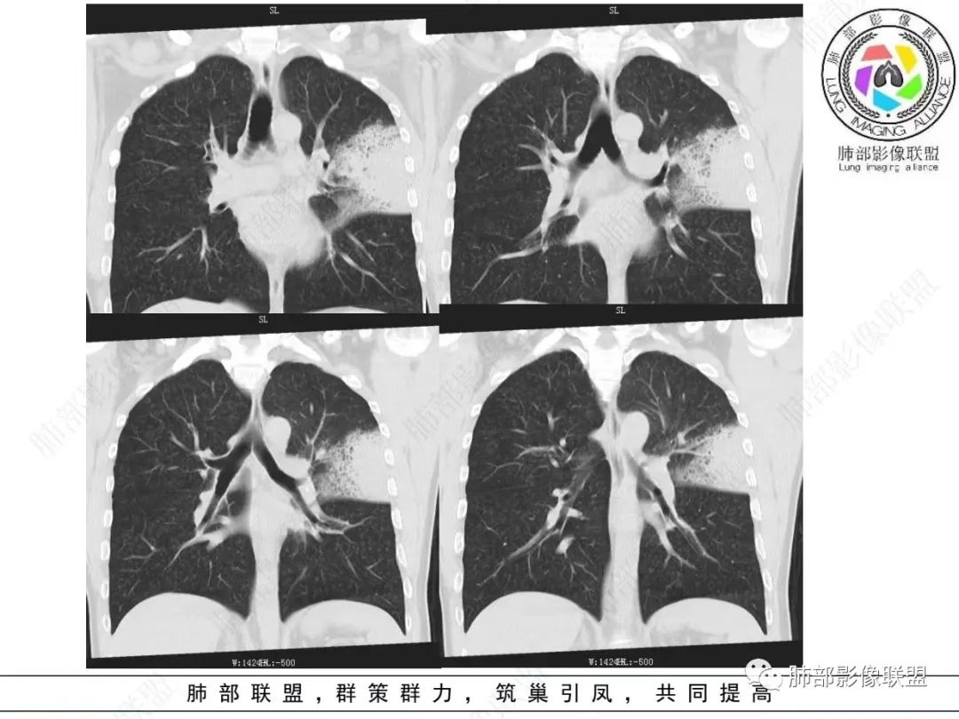 影像PPT - 【病例】 最经典的肺炎型肺癌1例CT-17 影像PPT - 【病例】 最经典的肺炎型肺癌1例CT-17