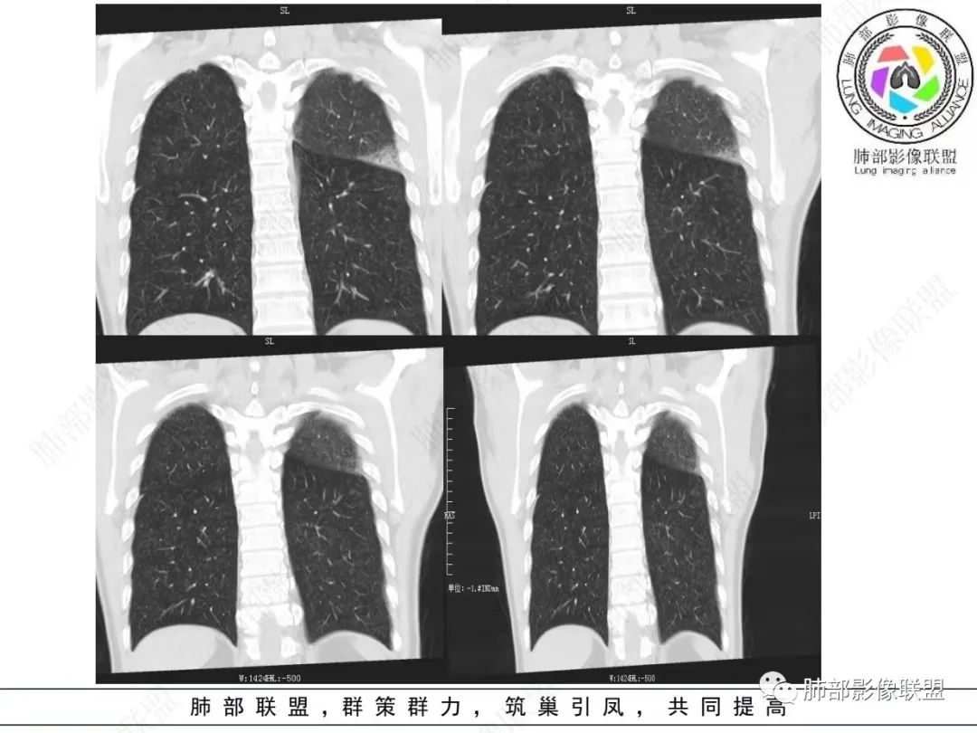 影像PPT - 【病例】 最经典的肺炎型肺癌1例CT-19 影像PPT - 【病例】 最经典的肺炎型肺癌1例CT-19
