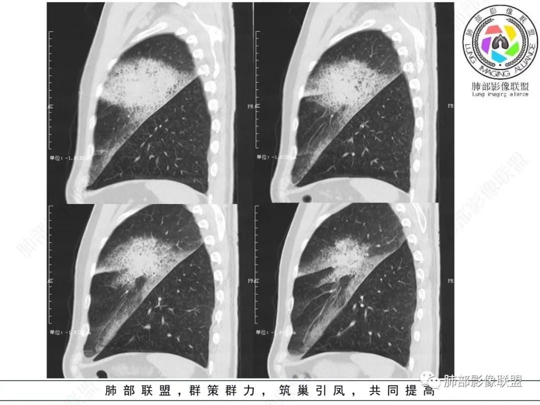 影像PPT - 【病例】 最经典的肺炎型肺癌1例CT-21 影像PPT - 【病例】 最经典的肺炎型肺癌1例CT-21