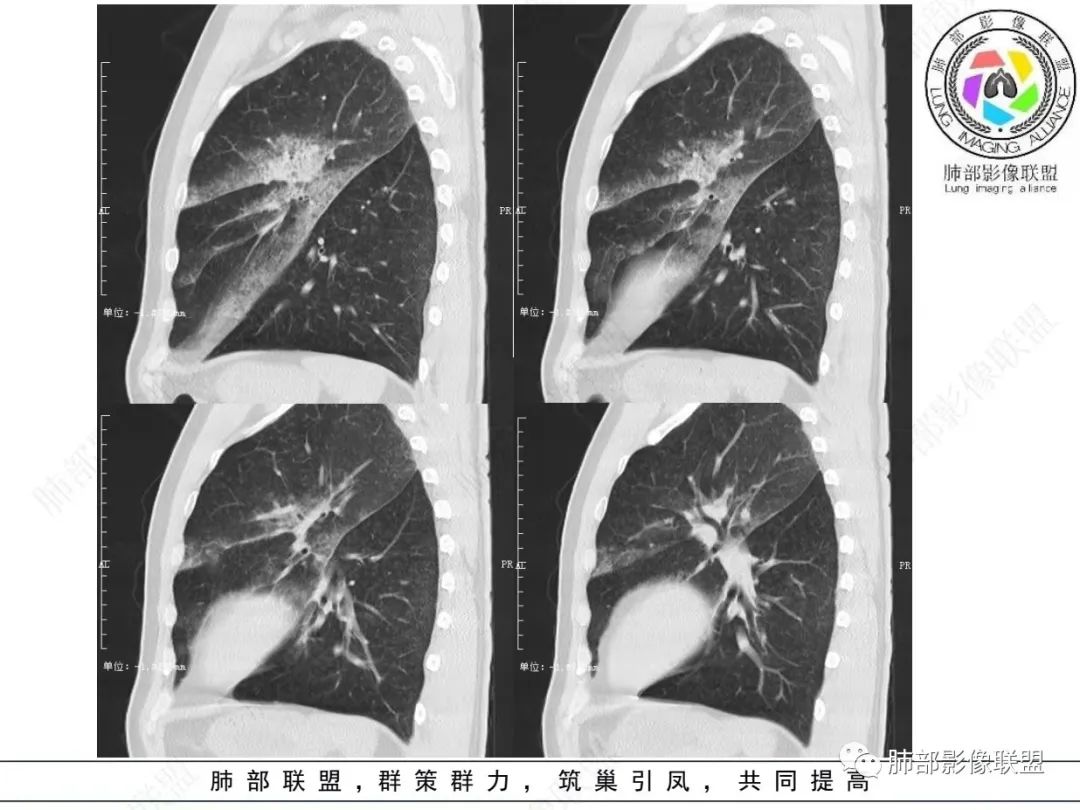 影像PPT - 【病例】 最经典的肺炎型肺癌1例CT-22 影像PPT - 【病例】 最经典的肺炎型肺癌1例CT-22