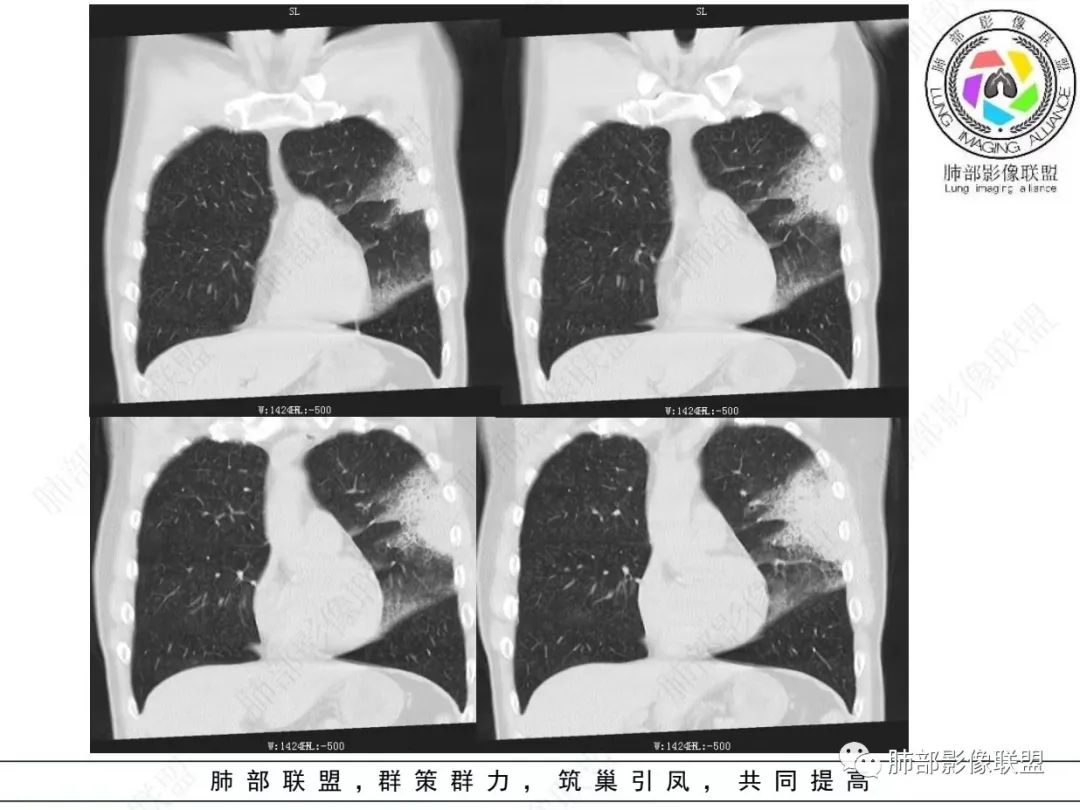 影像PPT - 【病例】 最经典的肺炎型肺癌1例CT-15 影像PPT - 【病例】 最经典的肺炎型肺癌1例CT-15