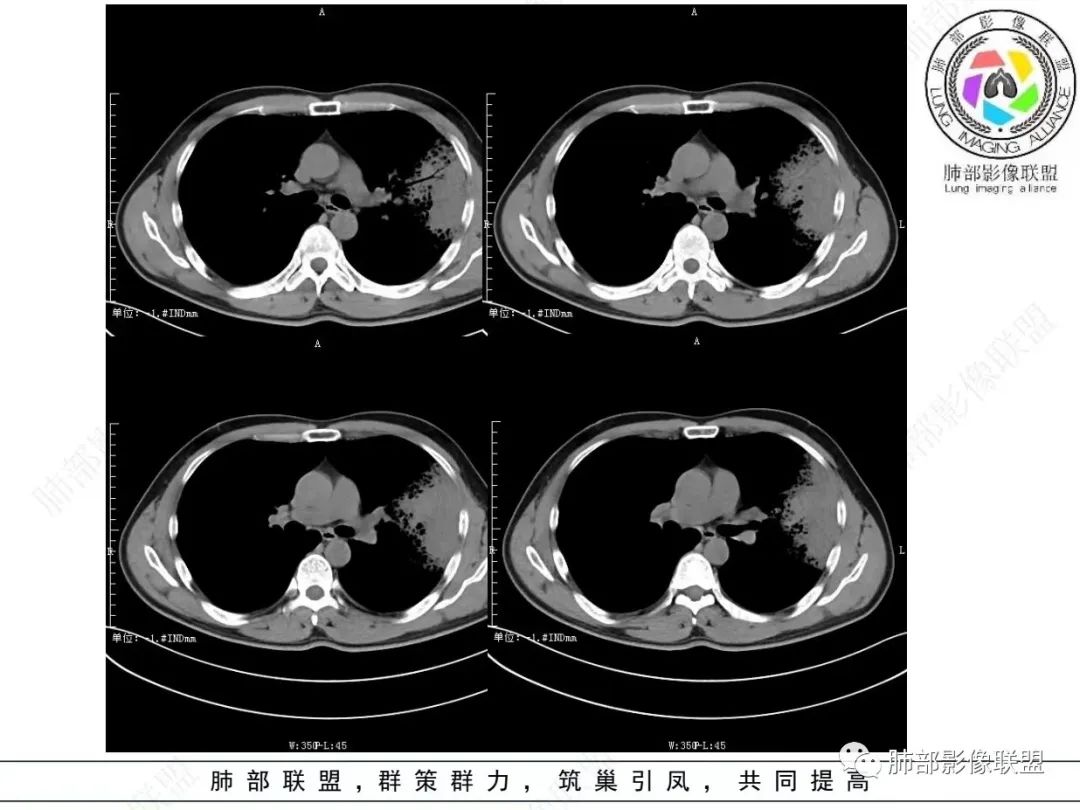 影像PPT - 【病例】 最经典的肺炎型肺癌1例CT-24 影像PPT - 【病例】 最经典的肺炎型肺癌1例CT-24
