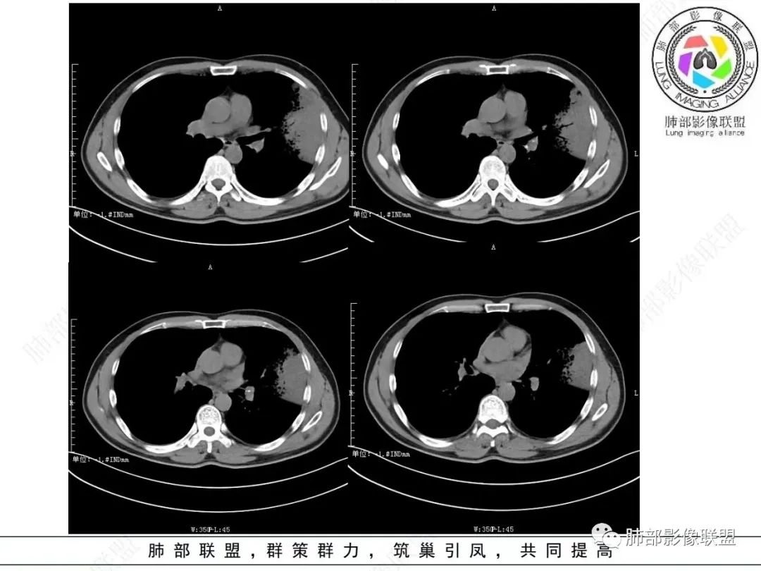 影像PPT - 【病例】 最经典的肺炎型肺癌1例CT-25 影像PPT - 【病例】 最经典的肺炎型肺癌1例CT-25