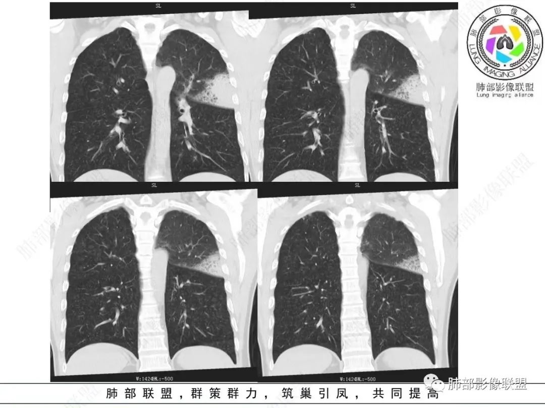 影像PPT - 【病例】 最经典的肺炎型肺癌1例CT-18 影像PPT - 【病例】 最经典的肺炎型肺癌1例CT-18