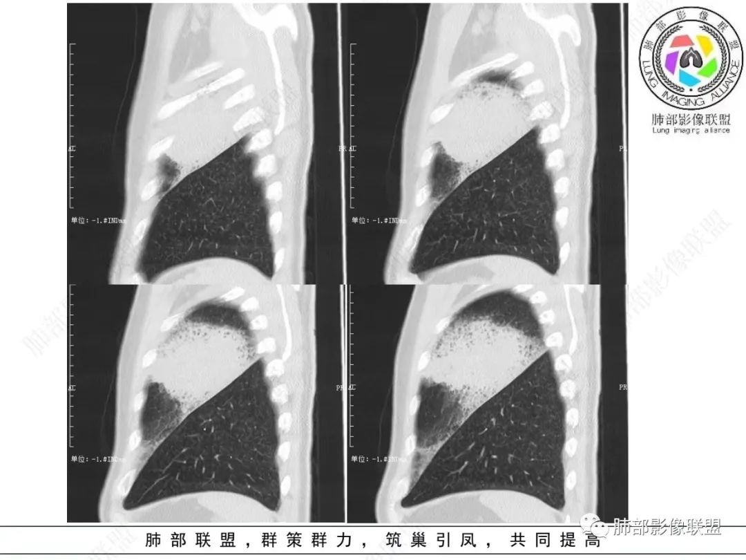 影像PPT - 【病例】 最经典的肺炎型肺癌1例CT-20 影像PPT - 【病例】 最经典的肺炎型肺癌1例CT-20