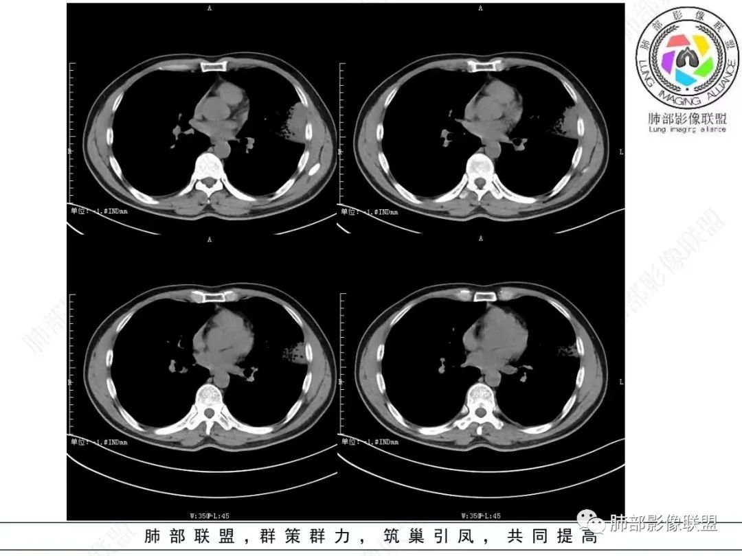 影像PPT - 【病例】 最经典的肺炎型肺癌1例CT-26 影像PPT - 【病例】 最经典的肺炎型肺癌1例CT-26