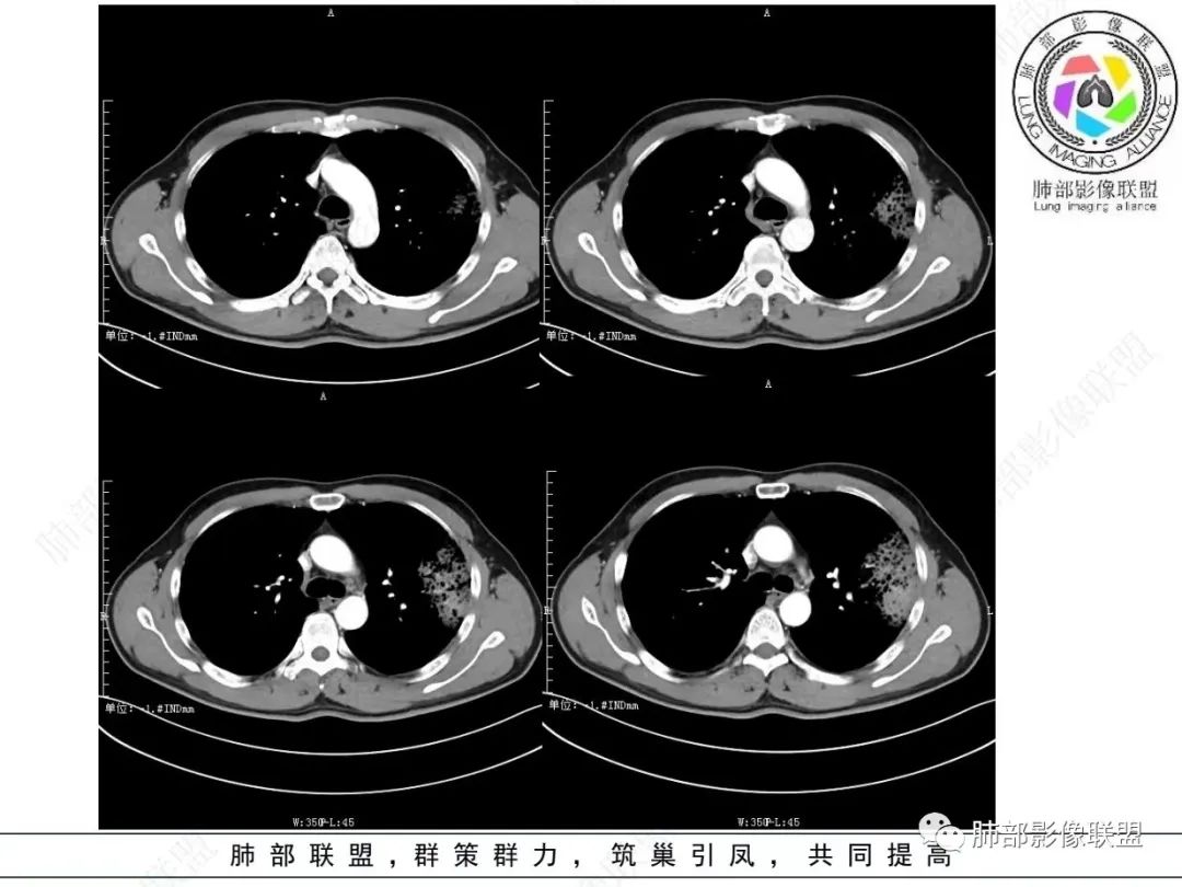 影像PPT - 【病例】 最经典的肺炎型肺癌1例CT-27 影像PPT - 【病例】 最经典的肺炎型肺癌1例CT-27