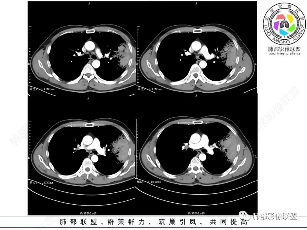 影像PPT - 【病例】 最经典的肺炎型肺癌1例CT-28 影像PPT - 【病例】 最经典的肺炎型肺癌1例CT-28