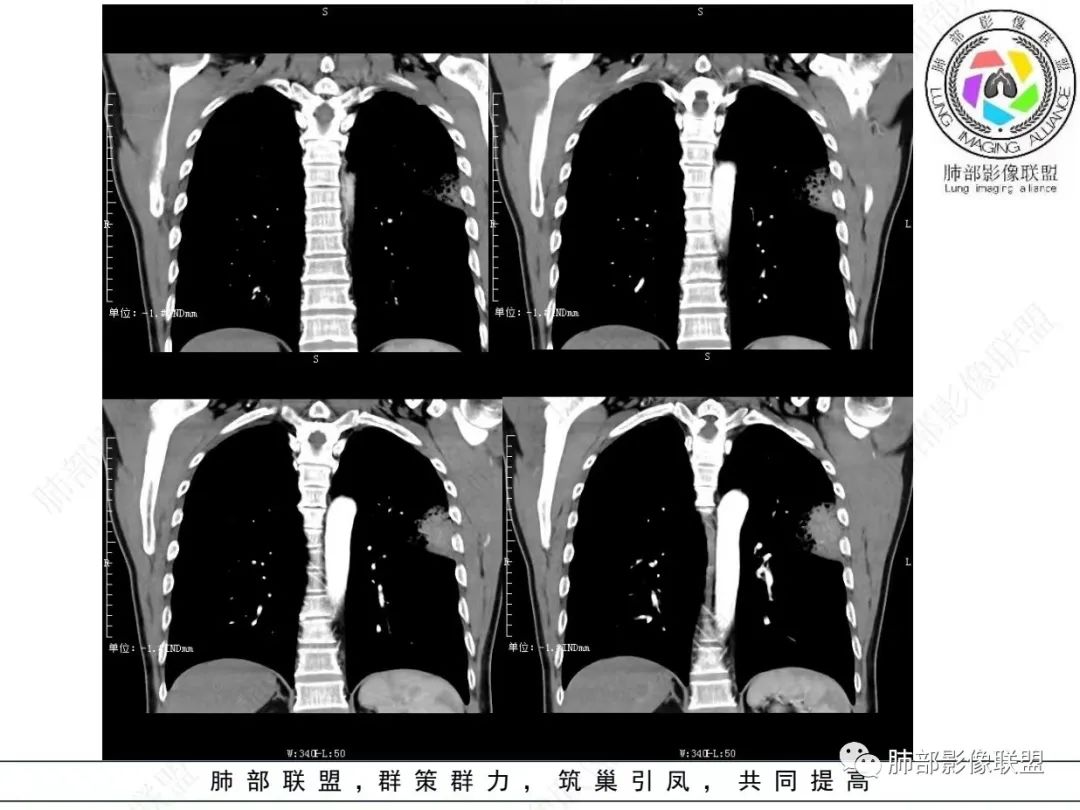 影像PPT - 【病例】 最经典的肺炎型肺癌1例CT-31 影像PPT - 【病例】 最经典的肺炎型肺癌1例CT-31