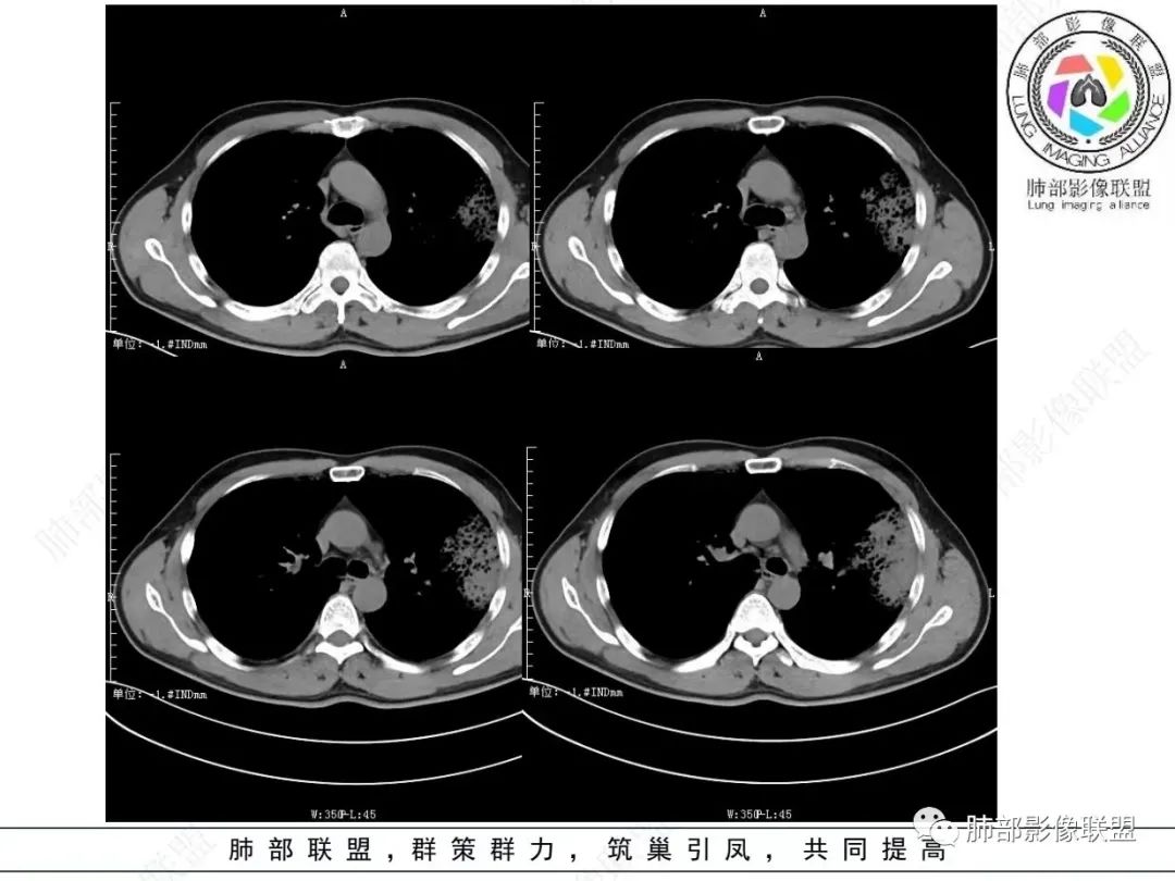 影像PPT - 【病例】 最经典的肺炎型肺癌1例CT-23 影像PPT - 【病例】 最经典的肺炎型肺癌1例CT-23