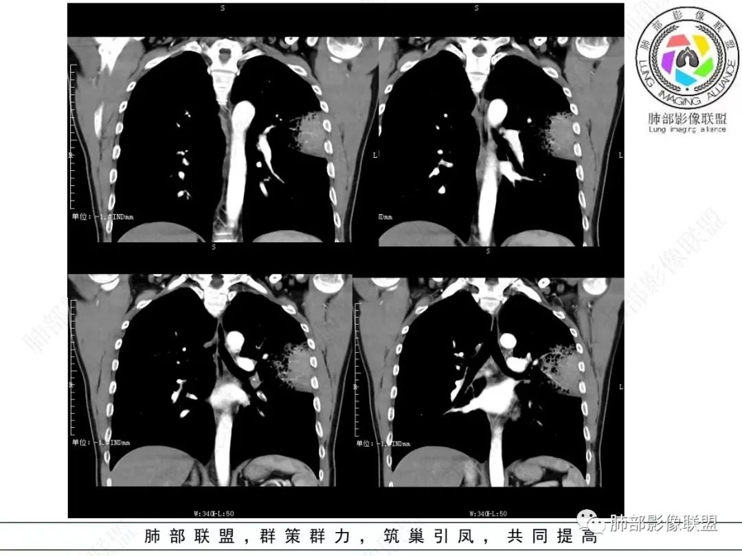 影像PPT - 【病例】 最经典的肺炎型肺癌1例CT-32 影像PPT - 【病例】 最经典的肺炎型肺癌1例CT-32